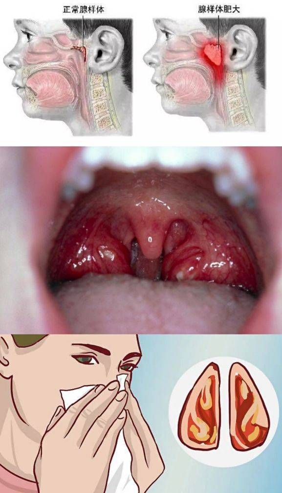 孩子睡觉打呼噜怎么办?