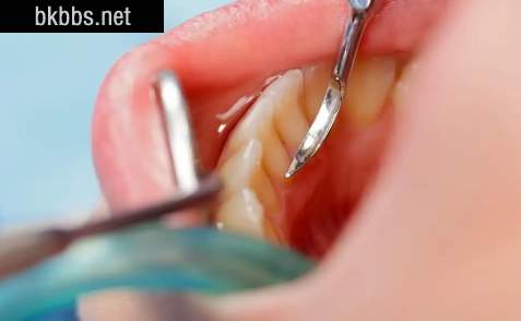 抠牙结石工具叫什么3