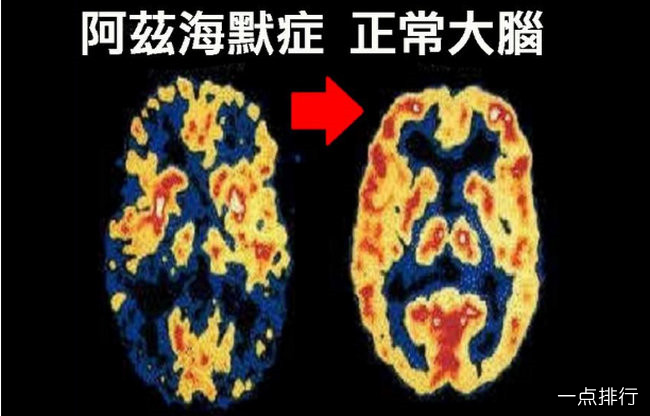 世界首款阿兹海默药问世 人类不再惧怕脑海中的橡皮擦